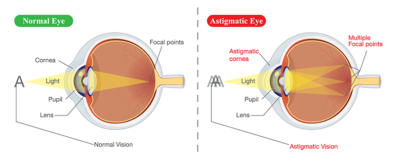 astigmatism