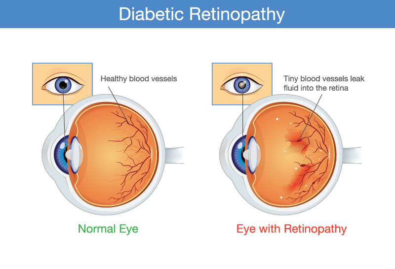 diabetic retinopathy